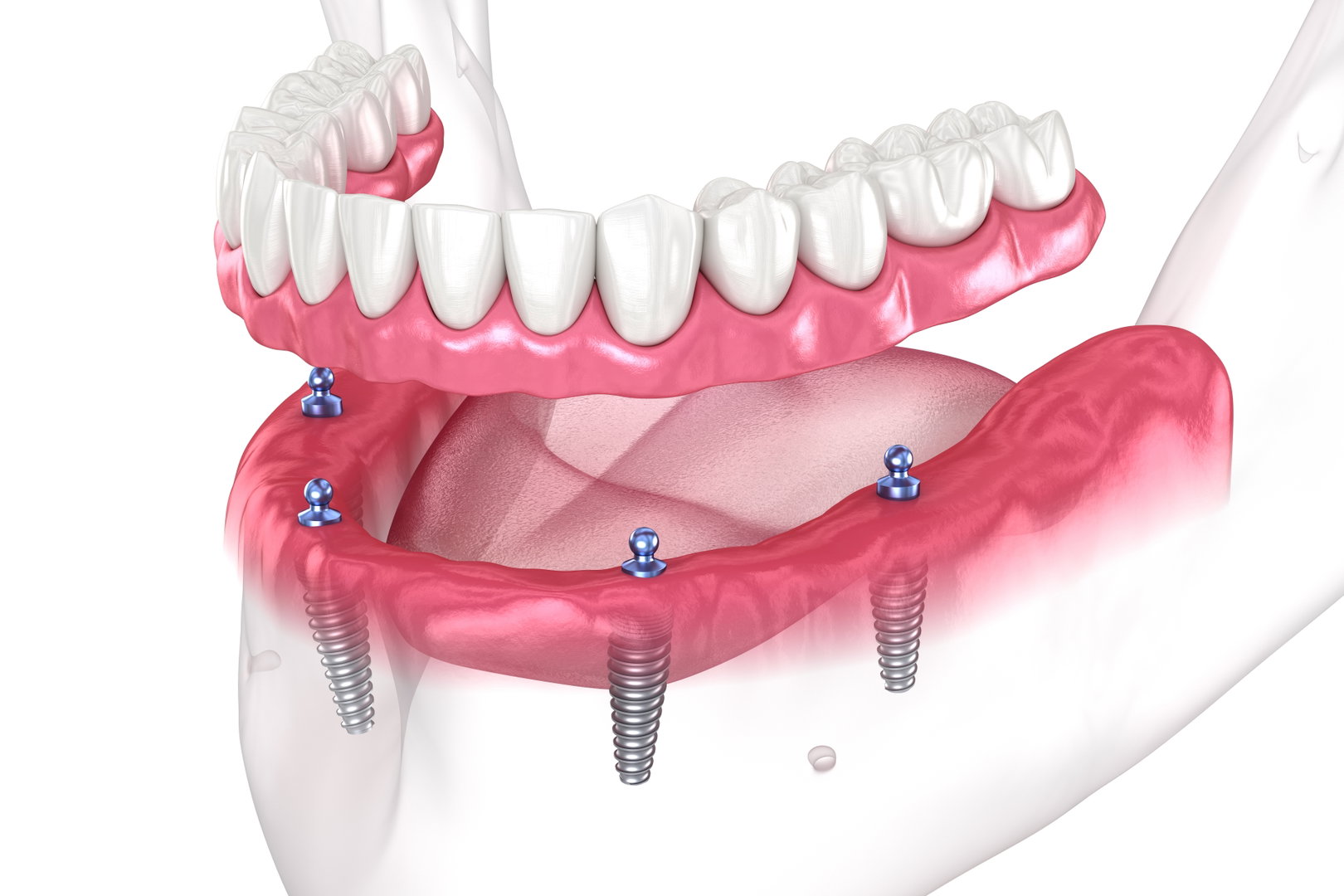 best-implant-treatment3