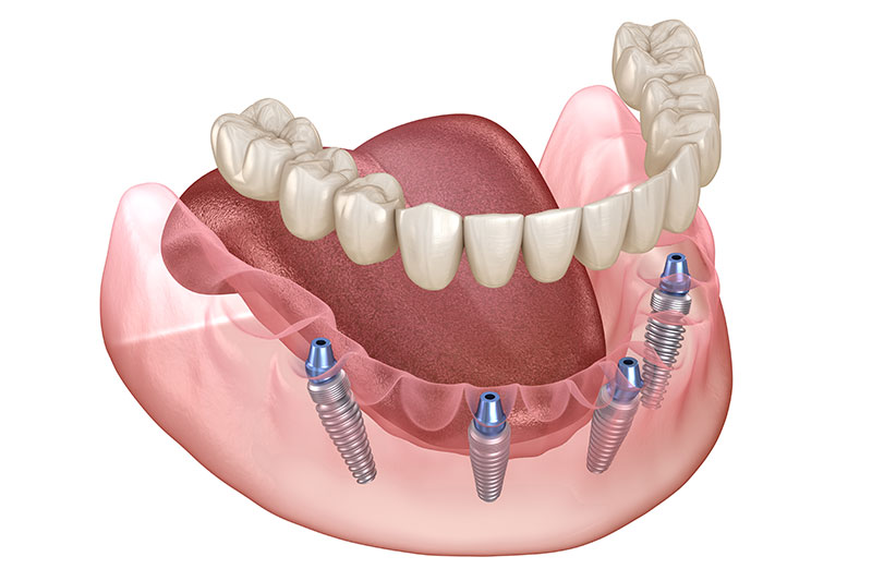 All on 4 Dental Implants in Henderson