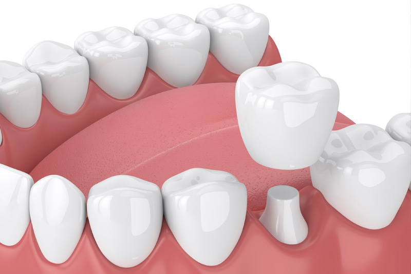 Dental Crowns in Henderson