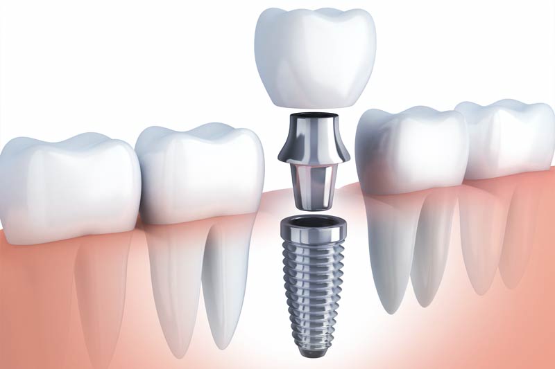 Dental Implants in Henderson