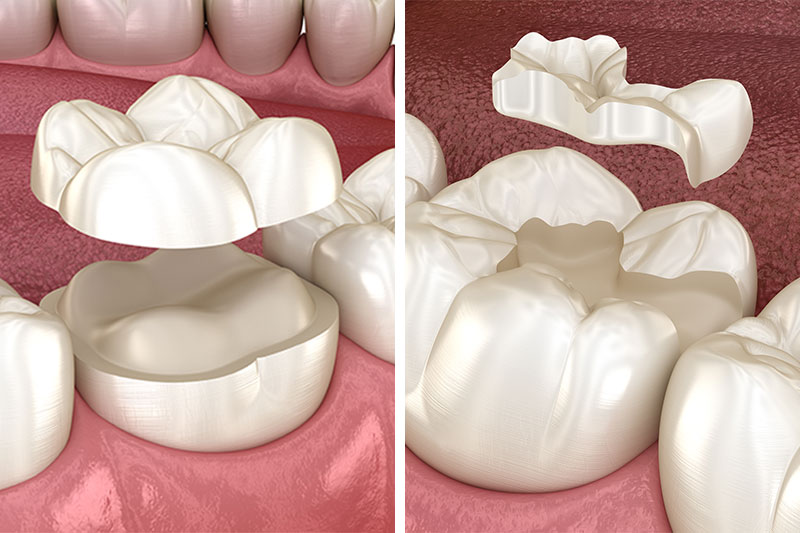 Dental Inlays and Onlays in Henderson