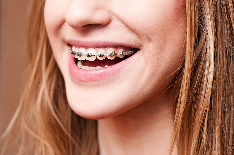 Orthodontics in Henderson