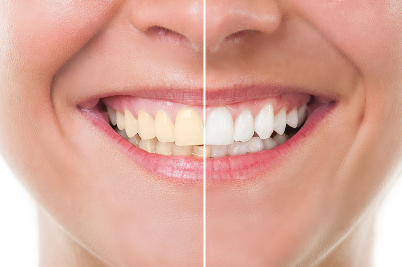 Zoom Teeth Whitening in Henderson