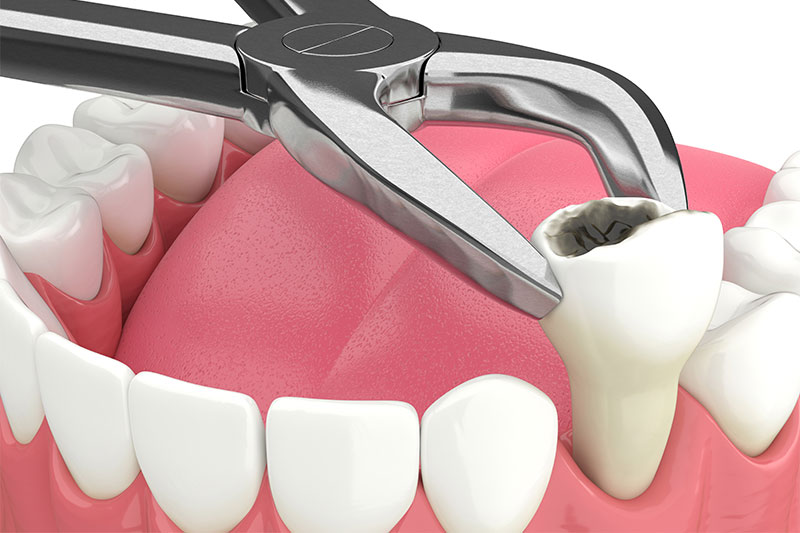 Tooth Extraction in Henderson