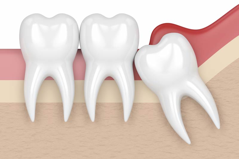 Wisdom Tooth Removal in Henderson