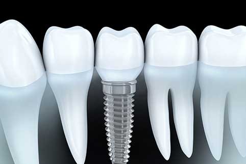 Dental Implants