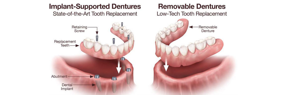 implant vs traditional denture
