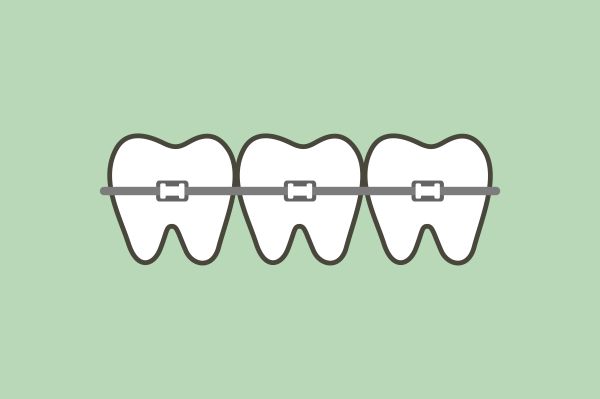 What Are Dental Appliances?