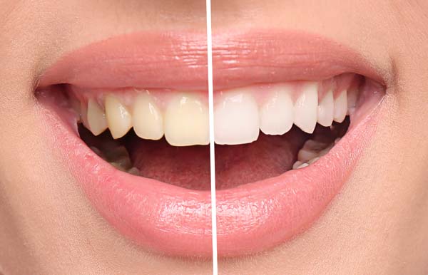 Teeth Whitening Henderson, TX